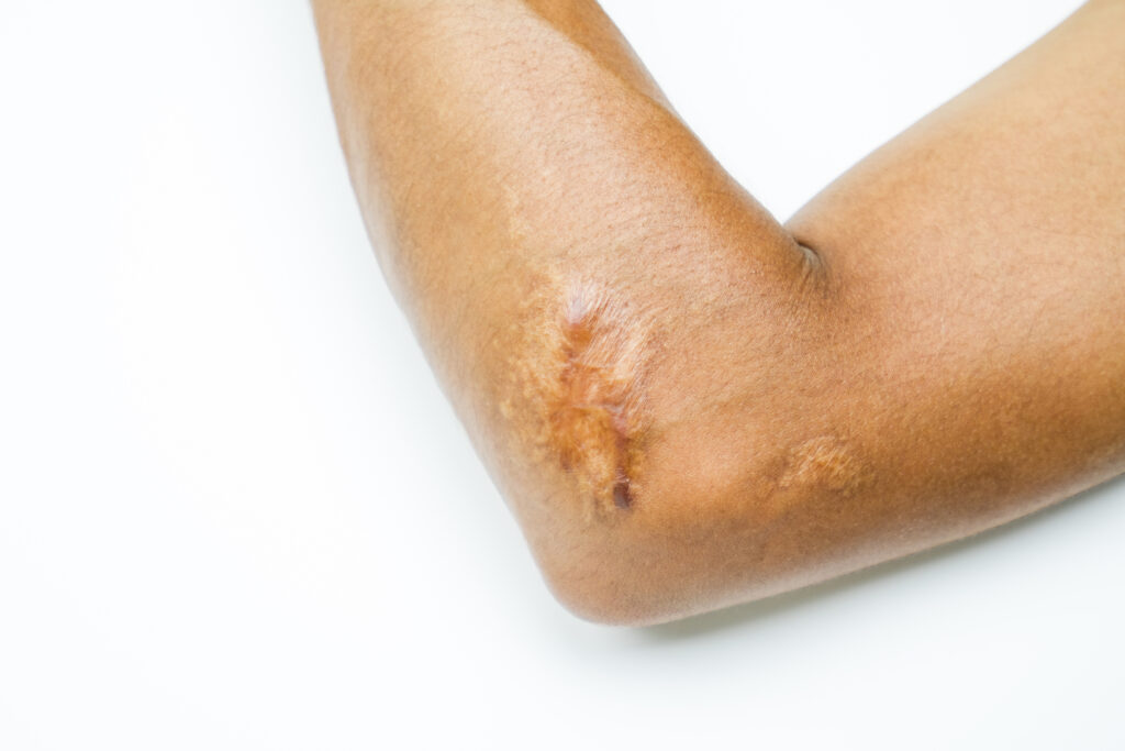 vecteezy keloid scar on elbow skin hypertrophic scar treatment by 7774190 48